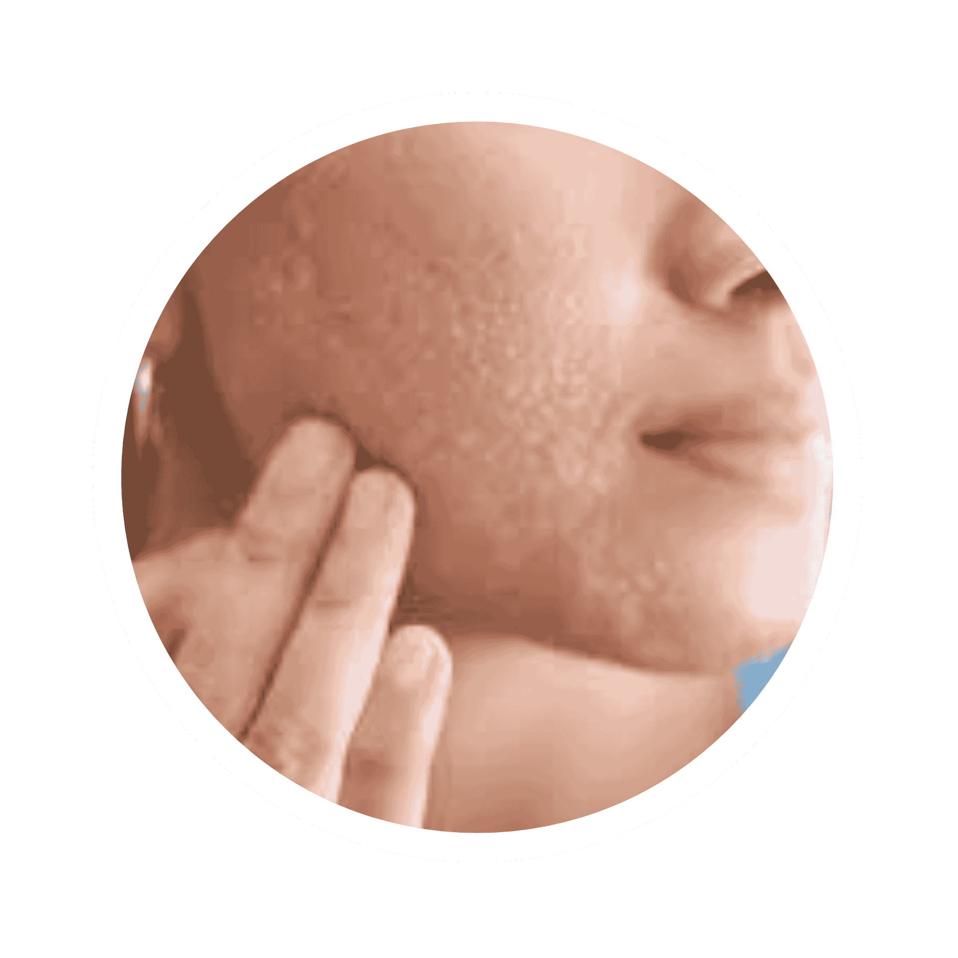 Acne Prone Skin
