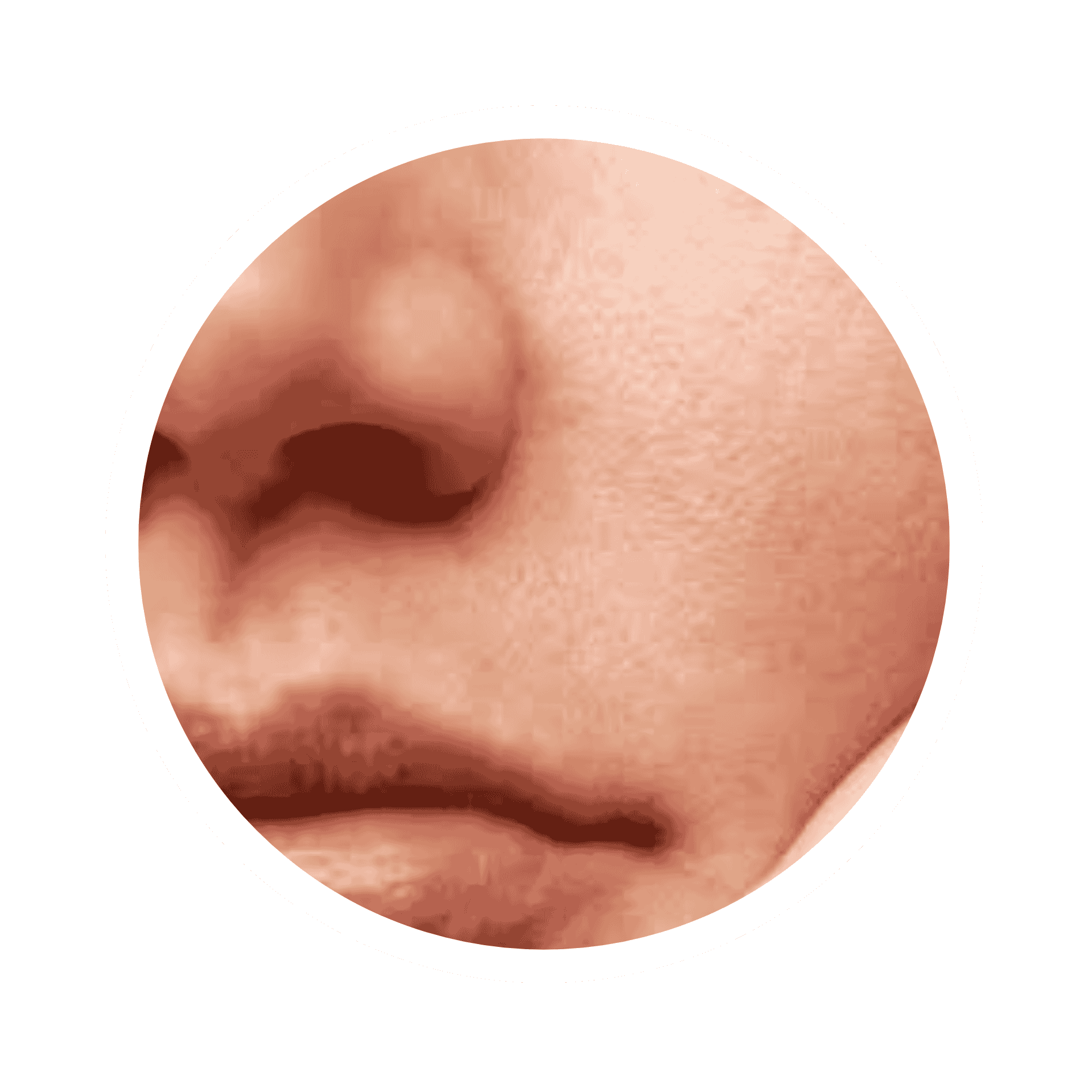 Acne Prone Skin