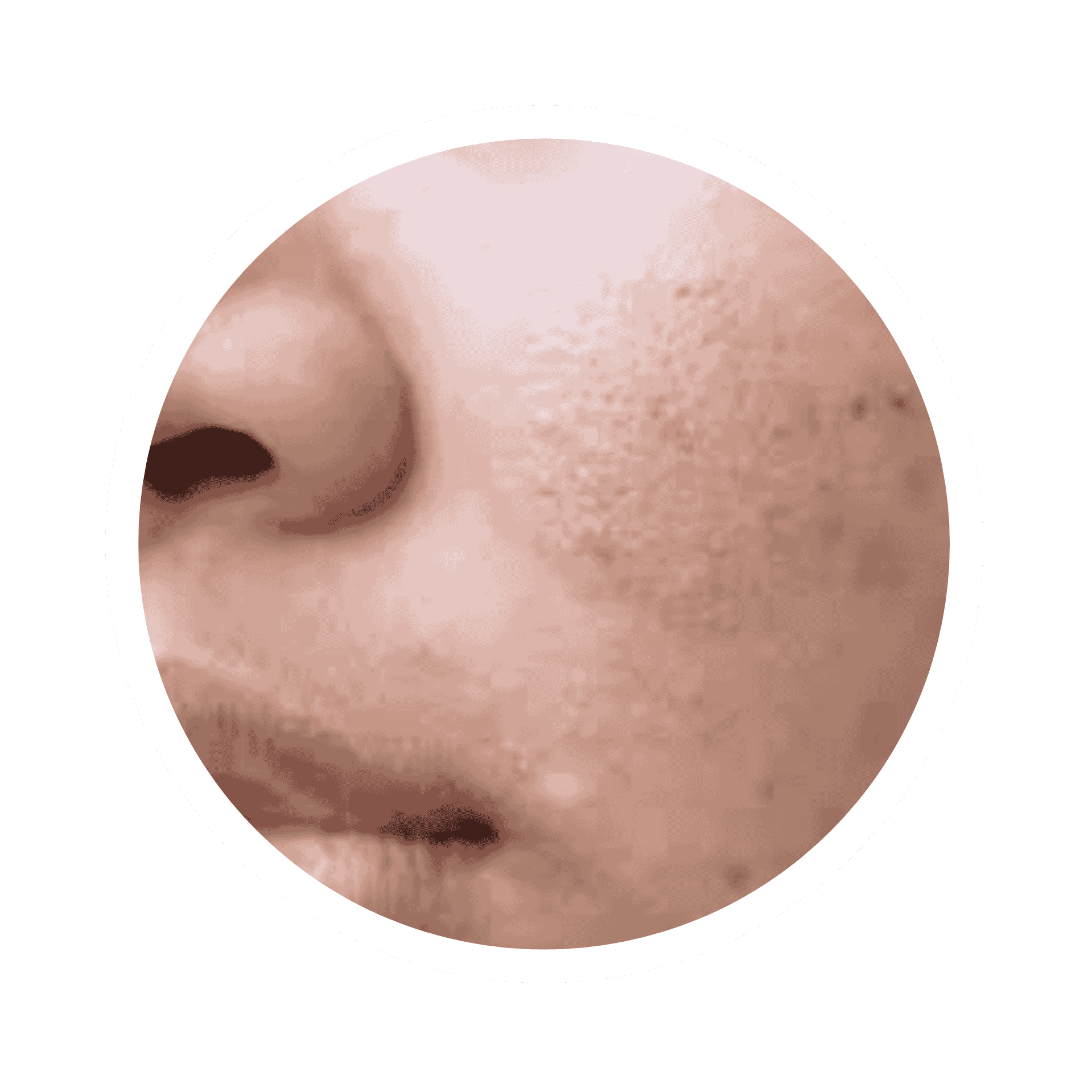 Acne Prone Skin