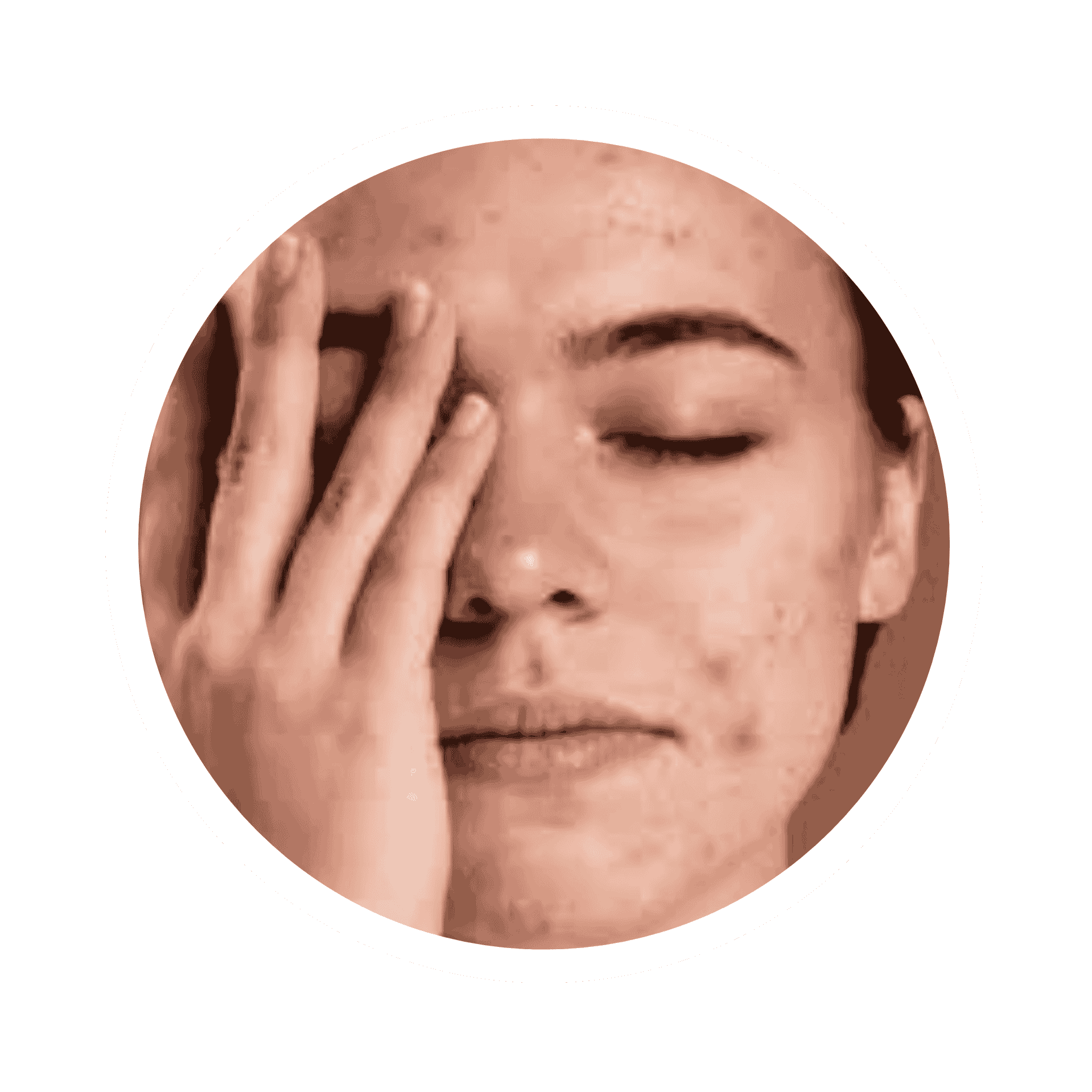 Acne Prone Skin