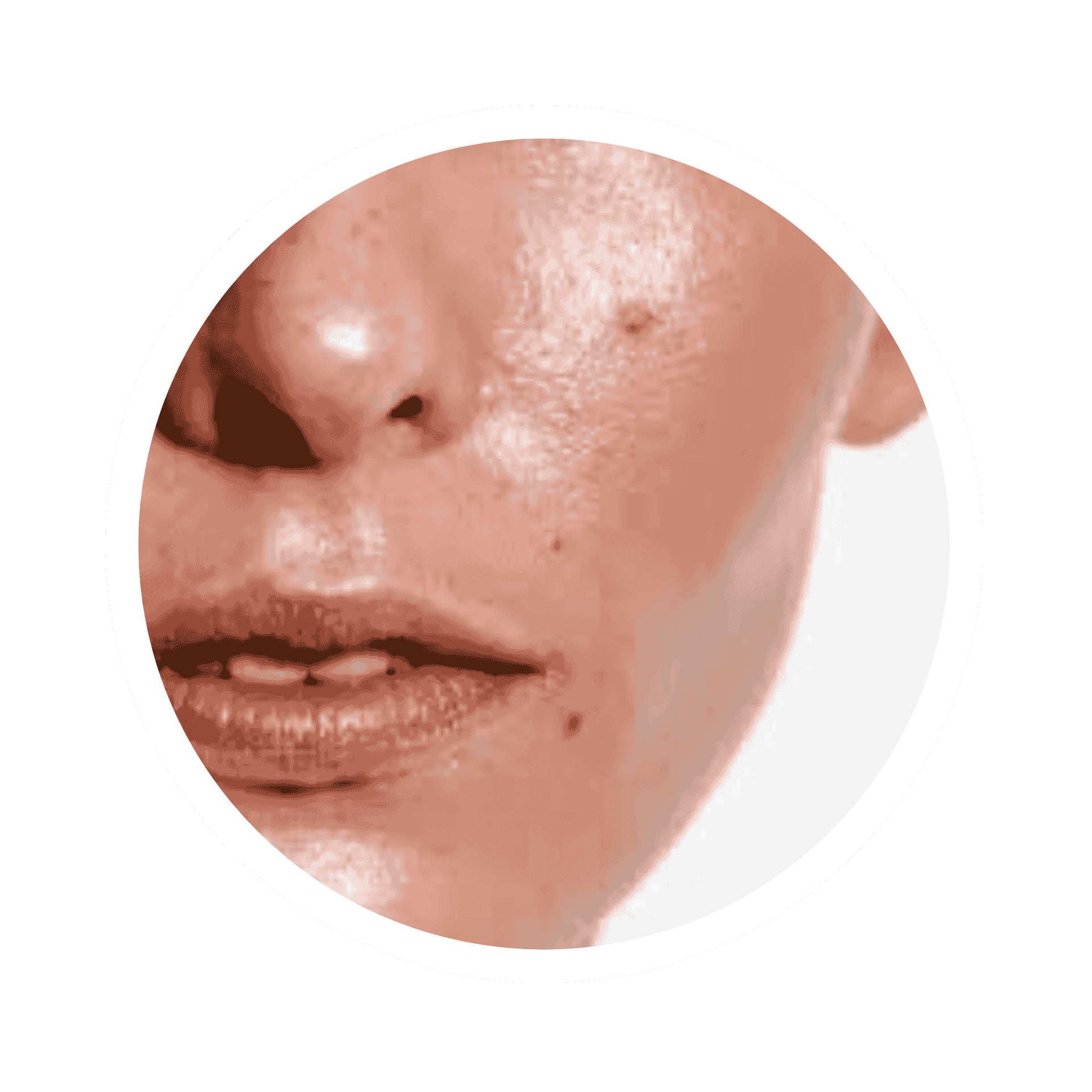 Acne Prone Skin