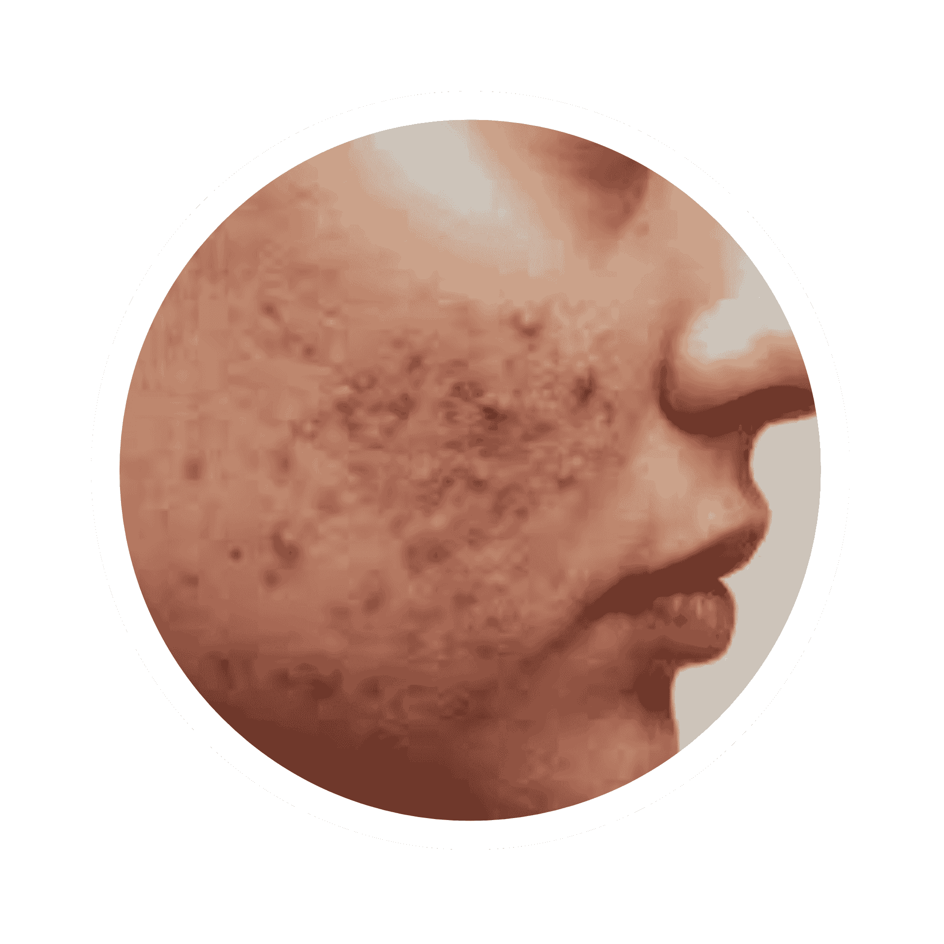 Acne Prone Skin