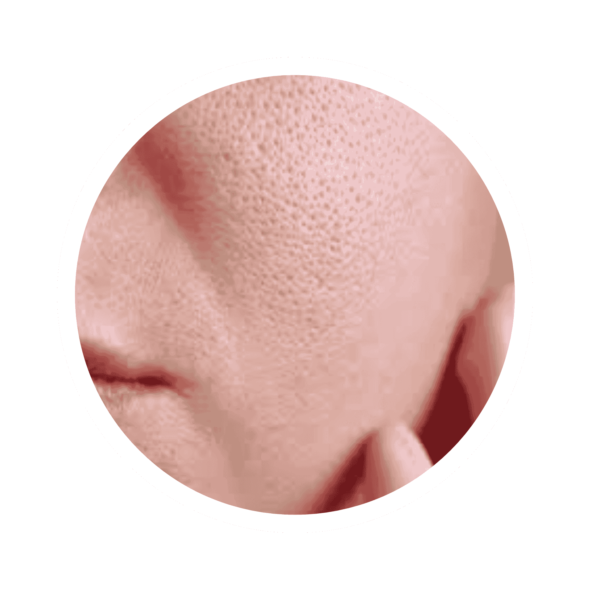Acne Prone Skin